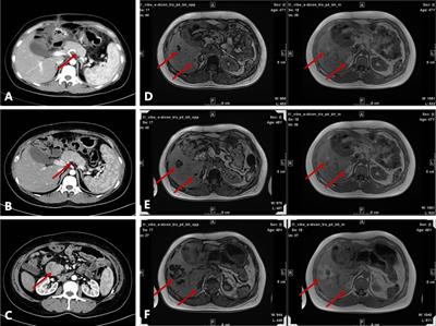 Case report: Peritumoral hepatic steatosis in a patient with a metastatic somatostatin-producing oligosymptomatic neuroendocrine neoplasm